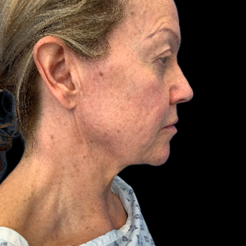 before-deep-plane-facelift-necklift-nanofat